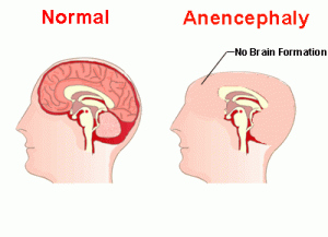 anencephaly1
