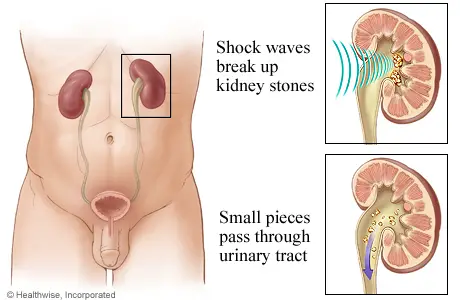 spina bifida Lithotripsy kidney stones, spina bifida Lithotripsy urinary tract stones