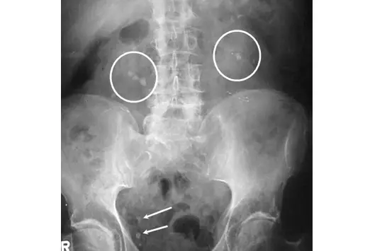 spina bifida Radiograph, spina bifida kidney stones, spina bifida kidney infection