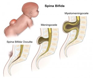 spina bifida kids treatment, spina bifida kids healthcare, spina bifida kids Pediatrics, spina bifida prevention, spina bifida kids diagnosis