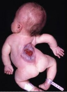 Eczema in babies | BabyCenter