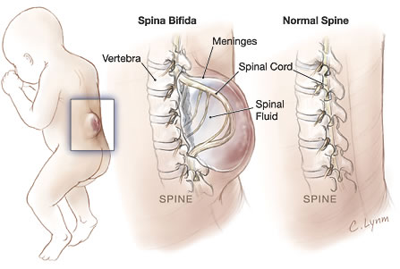 pictures of spina bifida, spina bifida images, spina bifida pictures