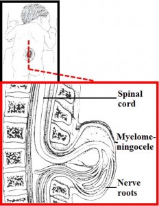 Lumbar Myelomeningocele