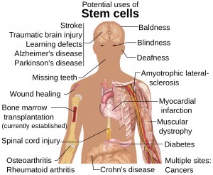 Stem Cell Treatment for Spina Bifida