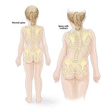 spina bifida back posture