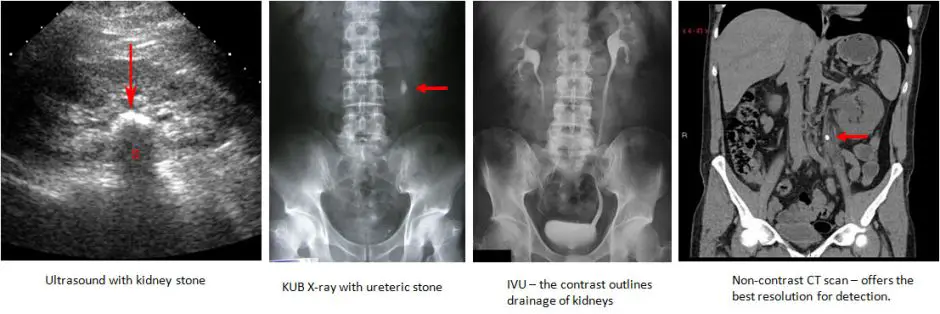 spina bifida IVU urinary tract stones, spina bifida IVU kidney stones