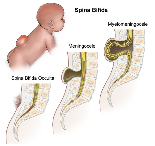 pictures of spina bifida, spina bifida images, spina bifida pictures