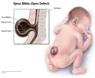 spina bifida pictures, spina bifida images, pictures of spina bifida,