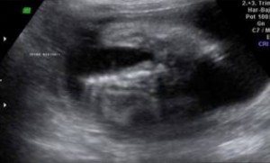 spina bifida ultrasound