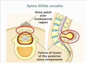 How Common is Spina Bifida