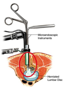 endoscopic spine surgery