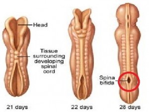 Spina Bifida Occulta Picture2