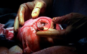 Spina Bifida Surgery in Utero
